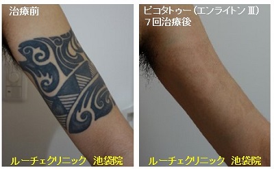 タトゥー除去ピコレーザー、7回、腕、黒