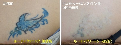 タトゥー除去ピコレーザー、9回、胸、黒、青
