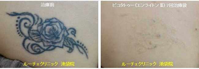 タトゥー除去ピコレーザー、7回、胸、黒、赤