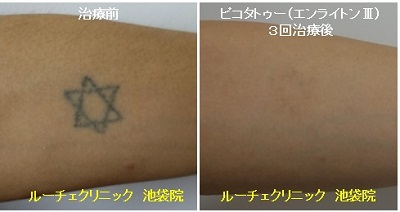 タトゥー除去ピコレーザー、３回、腕、黒
