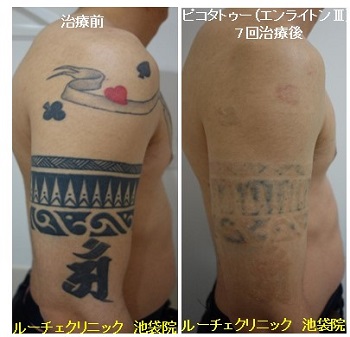 タトゥー除去ピコレーザー、7回、腕、黒、赤