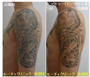 タトゥー除去ピコレーザー、1回、腕、黒