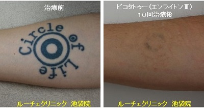 タトゥー除去ピコレーザー、10回、手首、黒