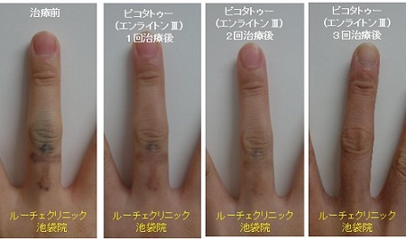 タトゥー除去ピコレーザー、3回、指、黒