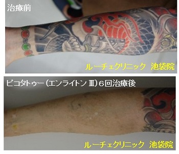 タトゥー除去ピコレーザー、6回、胸、黒、赤、緑、黄色
