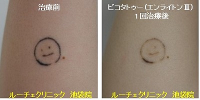 タトゥー除去ピコレーザー、1回、腕、黒