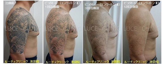 タトゥー除去ピコレーザー、5回、腕～胸、黒