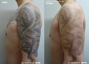 タトゥー除去、ピコレーザー、4回、腕、黒