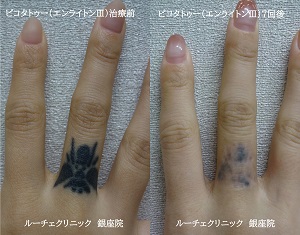 タトゥー除去ピコレーザー、7回、指、黒、
