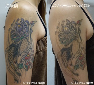 タトゥー除去ピコレーザー、1回、腕、黒、紫、緑