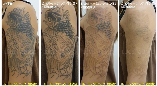 タトゥー除去ピコレーザー、6回、腕、黒