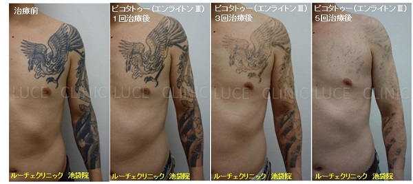 タトゥー除去ピコレーザー、5回、腕～胸、黒