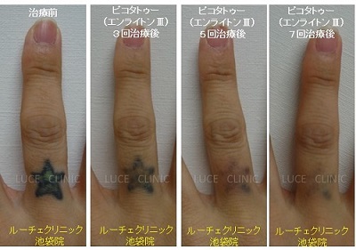タトゥー除去ピコレーザー、7回、指、黒、緑