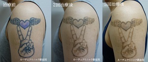 タトゥー除去ピコレーザー、３回、腕、黒、紫