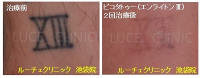 タトゥー除去ピコレーザー、2回、足、黒