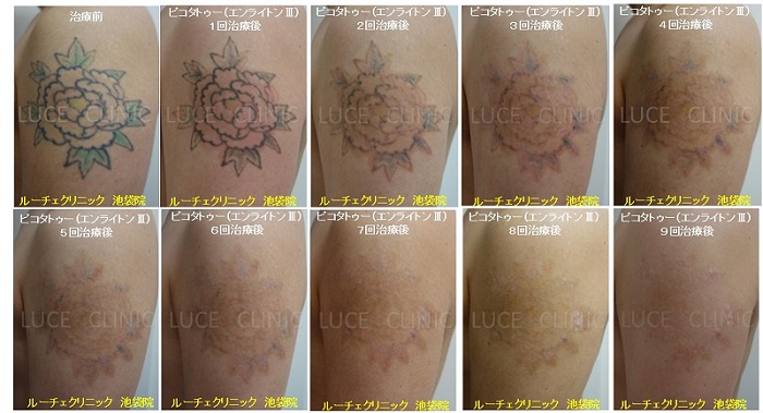 タトゥー除去ピコレーザー、9回、腕、黒、緑、赤、黄色
