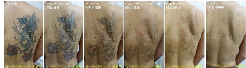 タトゥー除去ピコレーザー、10回、背中、黒、赤、緑、水色