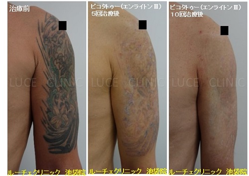 タトゥー除去ピコレーザー、10回、腕、黒、緑、赤