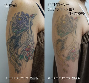 タトゥー除去ピコレーザー、2回、腕、黒、赤、紫、緑