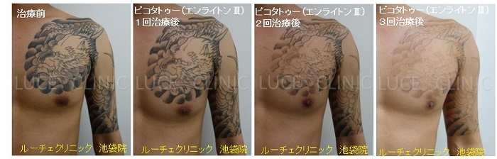タトゥー除去ピコレーザー、3回、胸～腕、黒