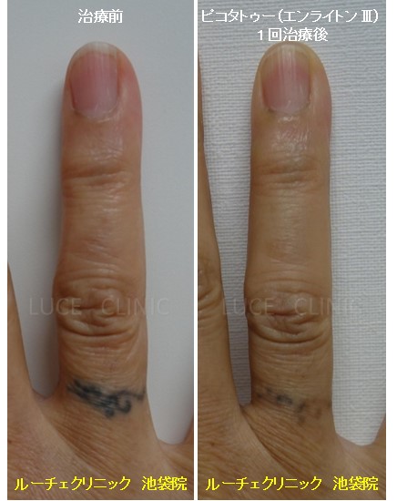 タトゥー除去ピコレーザー、1回、指、黒