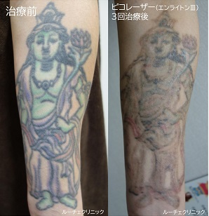 タトゥー除去ピコレーザー、３回、腕、黒、緑