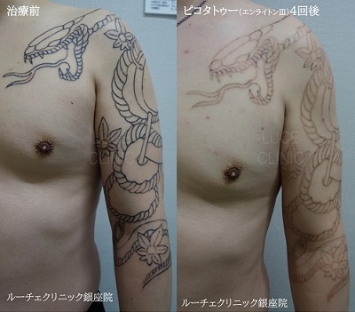 タトゥー除去ピコレーザー、４回、胸～腕、黒