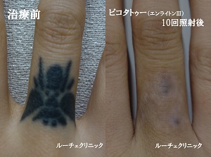 タトゥー除去ピコレーザー10回、指、黒