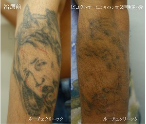 タトゥー除去ピコレーザー、2回、腕、黒、赤