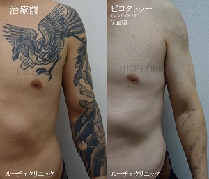 タトゥー除去ピコレーザー、7回、腕～胸、黒