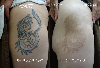 タトゥー除去ピコレーザー、5回、太もも、黒、水色