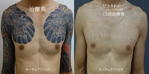 タトゥー除去ピコレーザー、12回、胸から腕、黒、赤