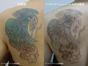 タトゥー除去ピコレーザー、背中、黒、水色、オレンジ