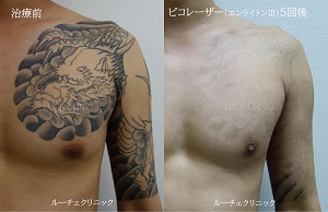 タトゥー除去ピコレーザー5回、胸、黒