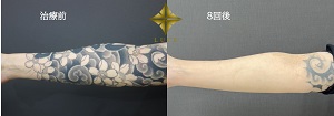 【症例】腕の黒いタトゥー除去｜ピコレーザーでの経過と回数｜ルーチェクリニック