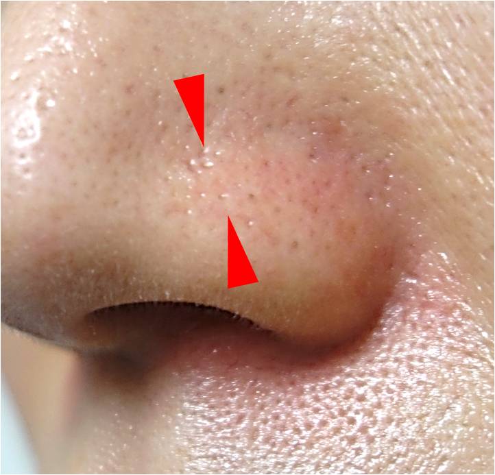 小鼻毛細血管拡張 エクセルv その３ 美容外科 皮膚科 婦人科形成のルーチェクリニック