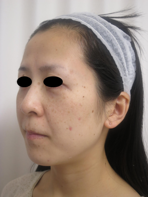 タトゥー除去ピコレーザー、4回、背中、黒