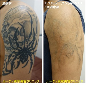 腕の黒のべったりと濃いドクロとクモのタトゥーを消します