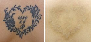 タトゥー除去ピコレーザー症例③ルーチェクリニック