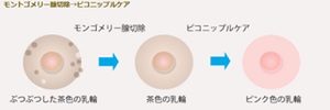バストトップのぷつぷつ（モントゴメリー腺）をとる