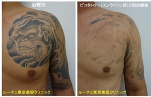 タトゥー除去ピコレーザー胸腕、黒＠ルーチェクリニック