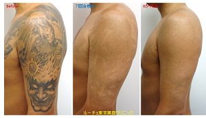 まだ残っている気がする、、それは「色素沈着」かもしれません。治療後の色素沈着について