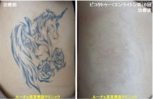 タトゥー除去ピコレーザー、6回、腰、黒、とれた