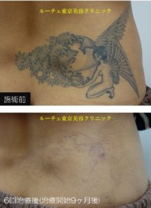 腰の黒タトゥー6回