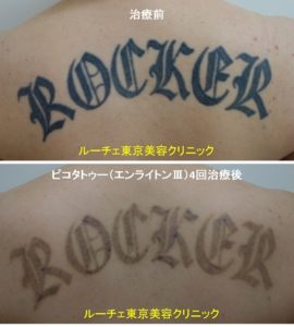 背中の黒くベったりと濃い色のインクを取ります 4回背中黒