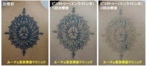 背中の黒く丸い形のタトゥーが薄くなっていく過程の経過写真　2回背中黒