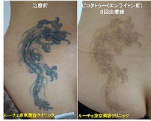 タトゥー除去ピコレーザー015＠ルーチェクリニック