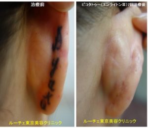 耳裏の黒いタトゥーが消えました