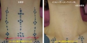 首のタトゥーがほぼ取れています。