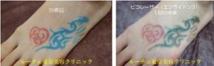 タトゥー除去ピコレーザー240＠ルーチェクリニック